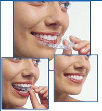 Invisalign coquitlam centre Invisalign