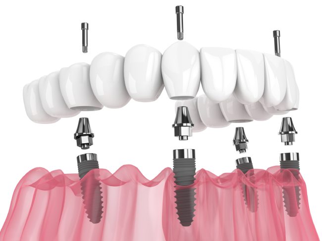 all-on-4-implants-cgs-dentistry