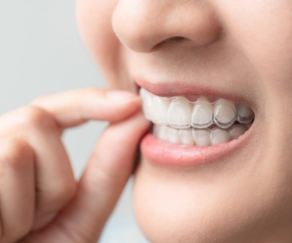 dental-appliances-at-cgs-dentistr