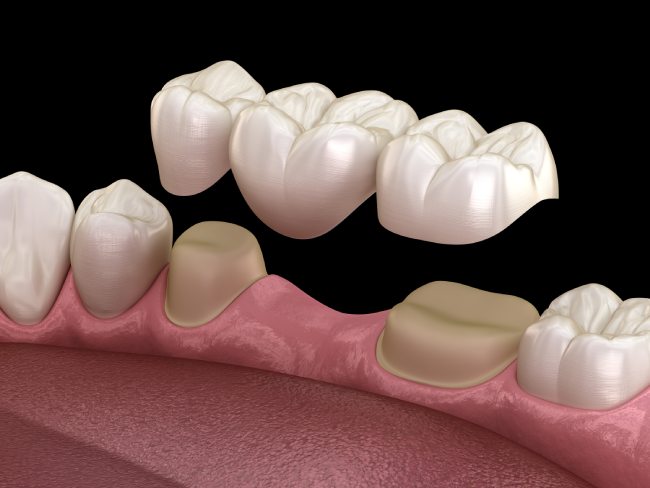 dental bridges-cgs-dentistry