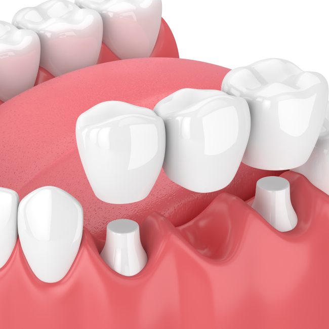 dental bridges in coquitlam