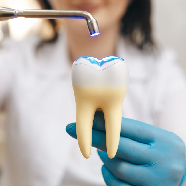 dental fillings in Coquitlam
