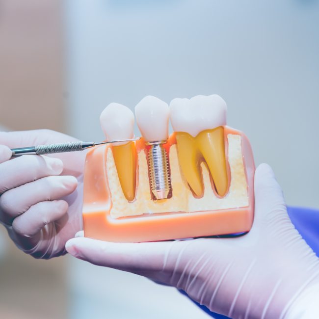 dental implants in Coquitlam