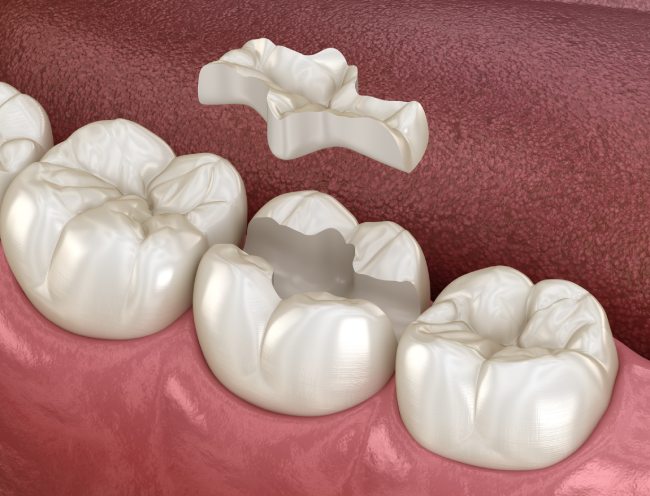 inlays onlays cgs dentistry