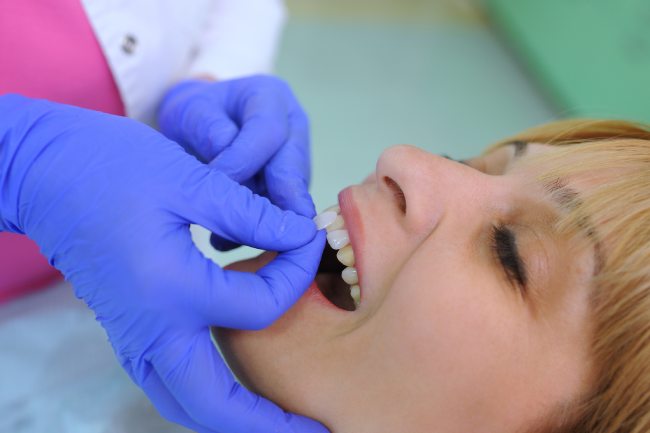 lumineers-cgs-dentistry