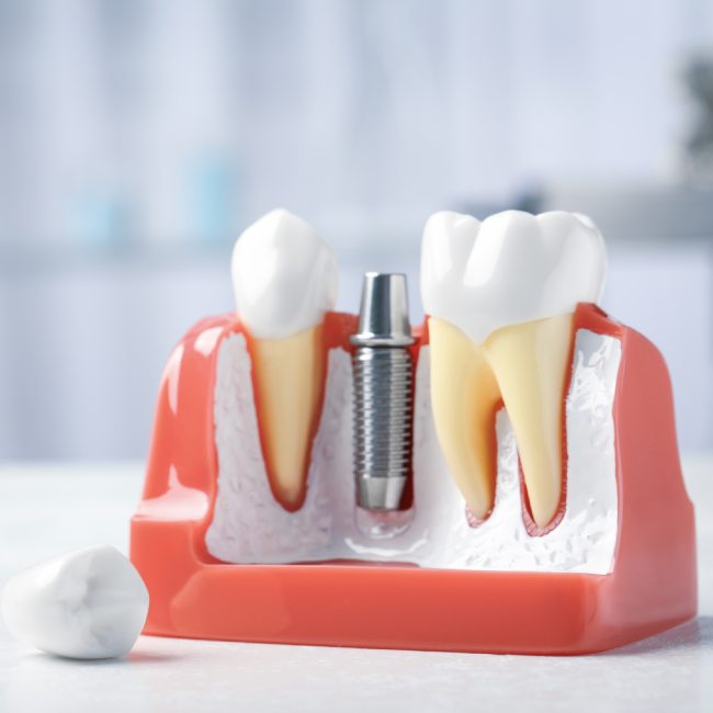 prosthodontics in Coquitlam