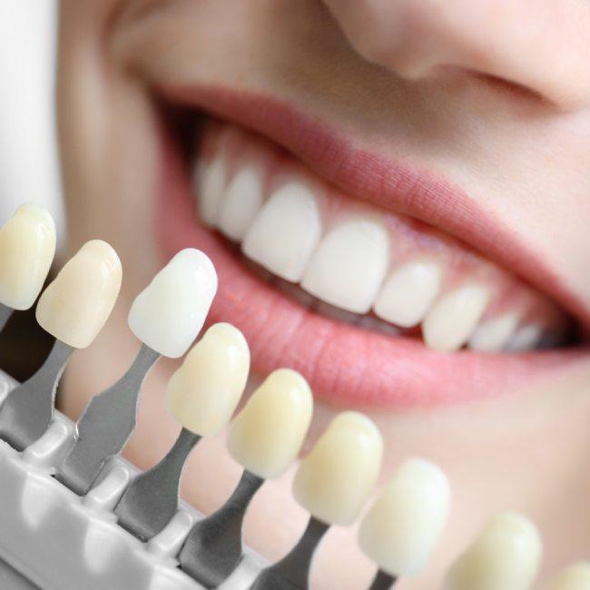 teeth whitening in Coquitlam