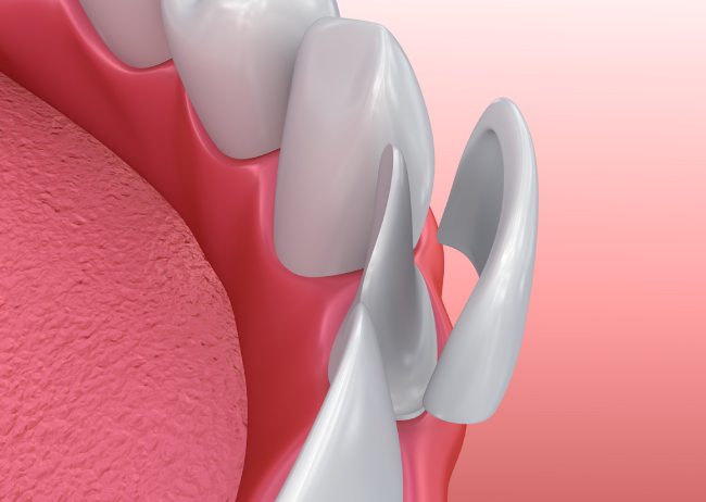 veneers-cgs-dentistry