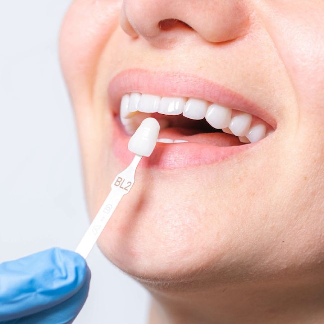 dental veneers in Coquitlam