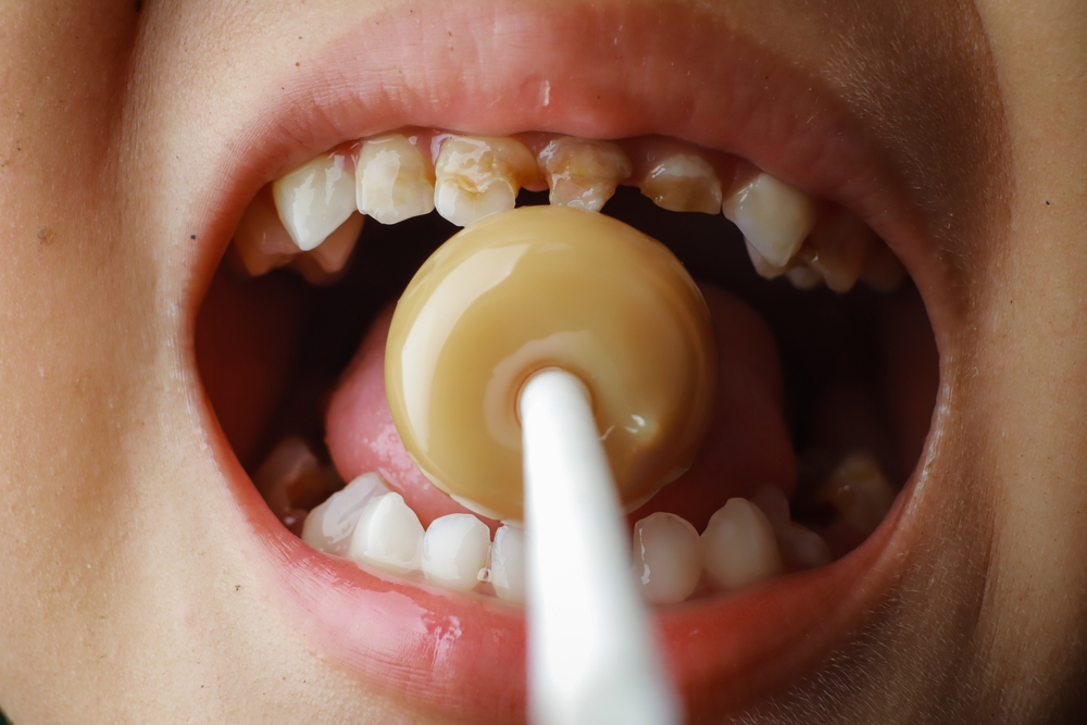proven ways to prevent cavities