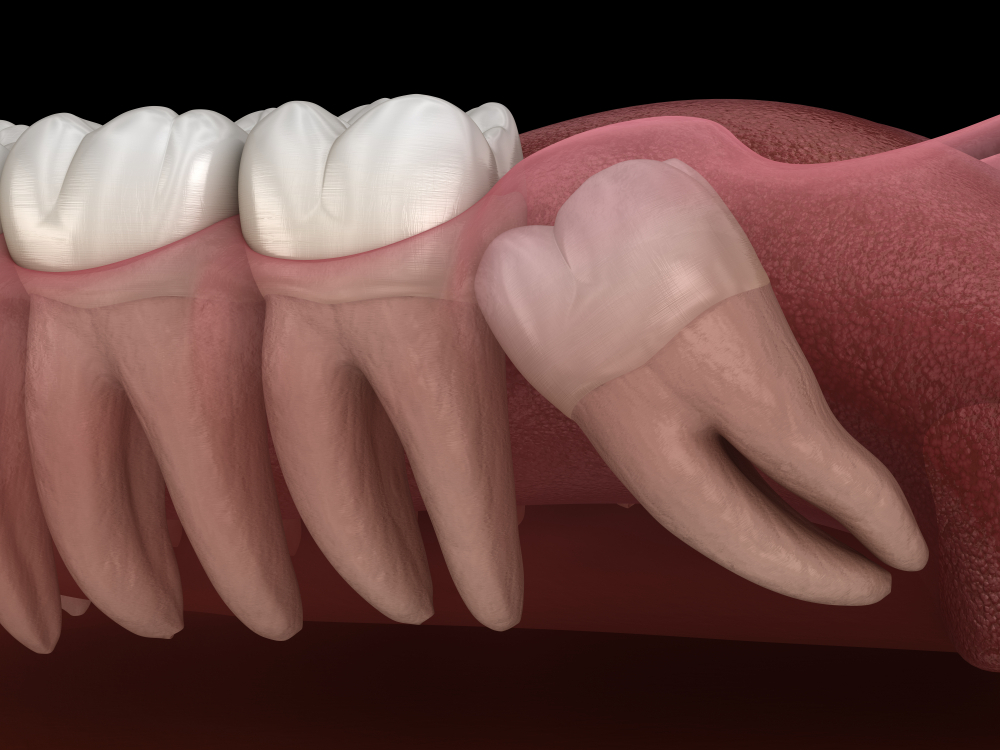 the facts about wisdom teeth